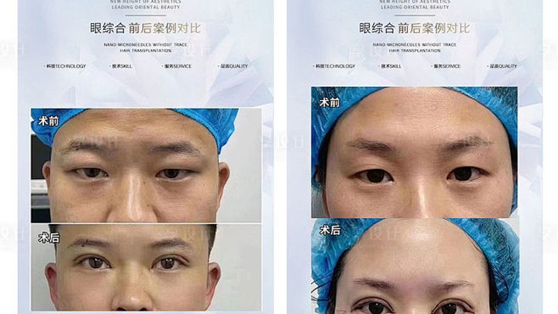 肉毒素注射术后护理方法