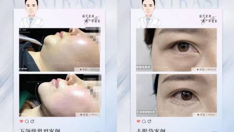 假体隆鼻歪斜？揭秘修复背后的秘密