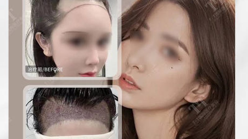 双眼皮术后，鸡蛋能吃吗？揭秘术后饮食真相