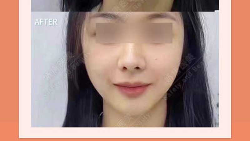 超声炮：揭秘医美界的“热力武器”，品牌排名背后的技术解析