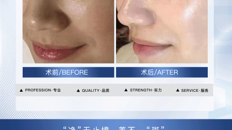 医美咨询师新手实战技巧：如何精准把握客户需求