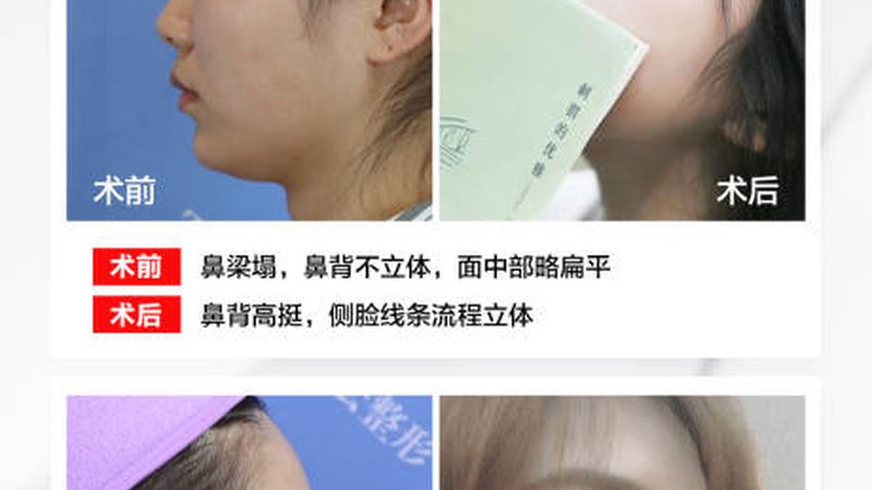 激光祛斑，设备参数揭秘：如何选择适合自己的设备？**