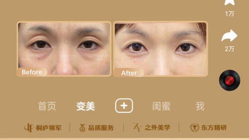 冰点脱毛与激光脱毛：如何选择更适合你的脱毛方法